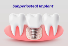 Subperiosteal Implant: What It Is, How It Works and Who Needs It