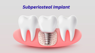 Subperiosteal Implant: What It Is, How It Works and Who Needs It